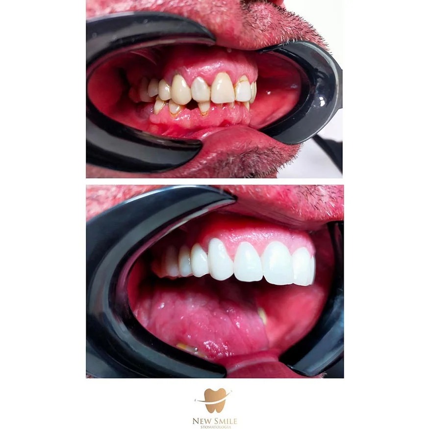 Efekt zabiegów stomatologii estetycznej