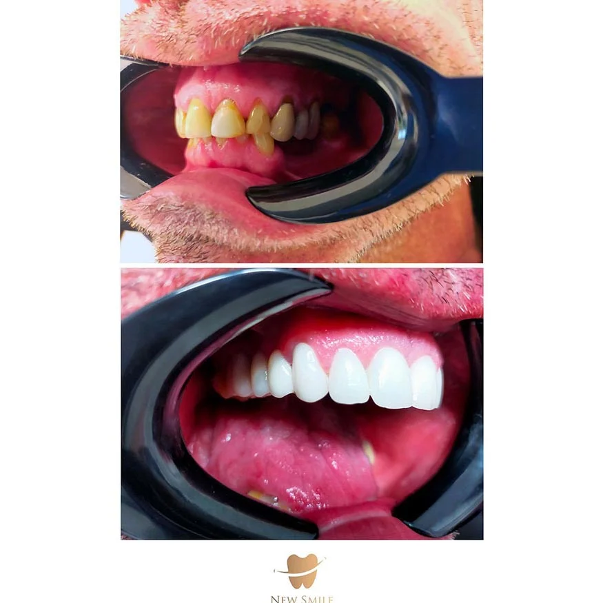 Efekt zabiegów stomatologii estetycznej